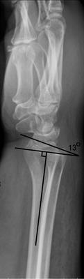 Mathematical model of distal radius orientation